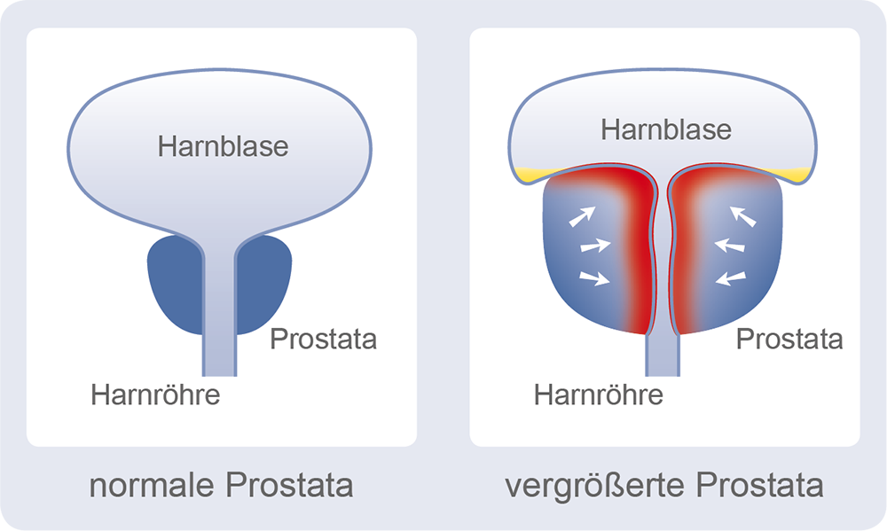 euviril - Die Prostata das Männerorgan